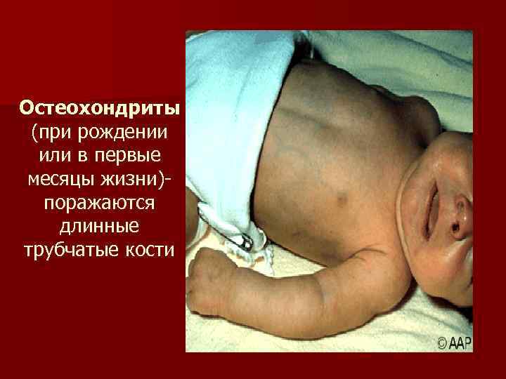 Остеохондриты (при рождении или в первые месяцы жизни)поражаются длинные трубчатые кости 