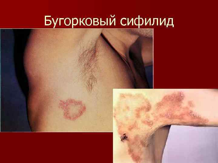 Бугорковый сифилид 