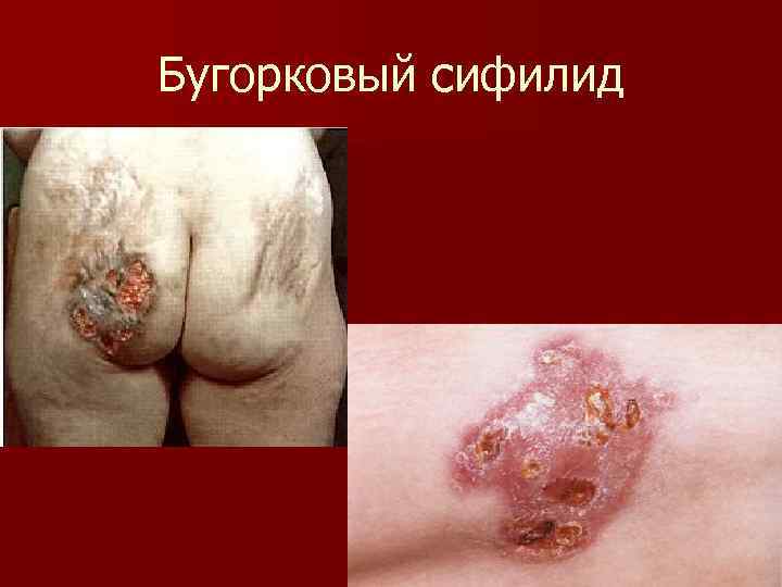 Бугорковый сифилид 
