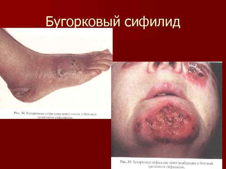 Бугорковый сифилид 