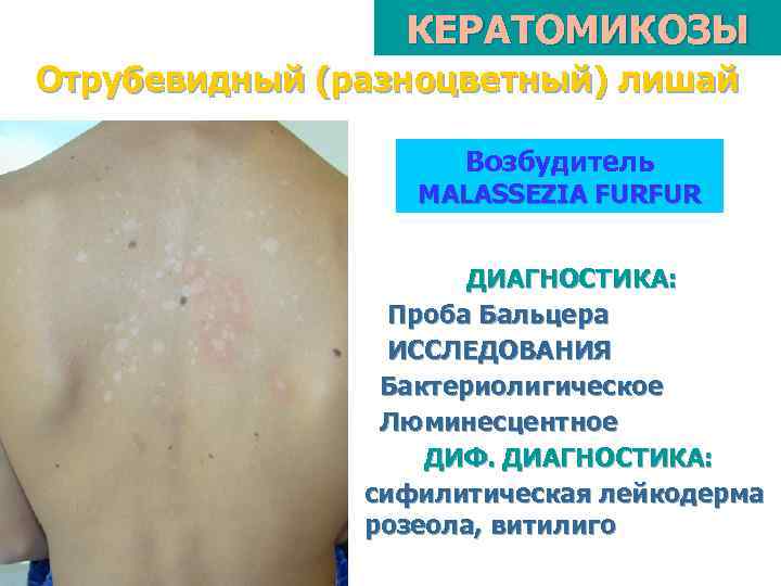 КЕРАТОМИКОЗЫ Отрубевидный (разноцветный) лишай Возбудитель MALASSEZIA FURFUR ДИАГНОСТИКА: Проба Бальцера ИССЛЕДОВАНИЯ Бактериолигическое Люминесцентное ДИФ.