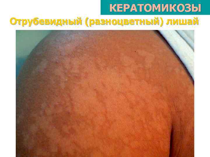 КЕРАТОМИКОЗЫ Отрубевидный (разноцветный) лишай 