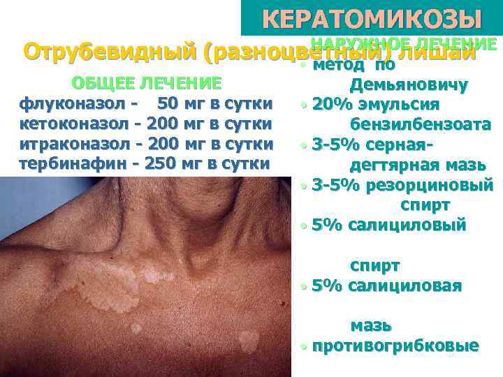 КЕРАТОМИКОЗЫ НАРУЖНОЕ ЛЕЧЕНИЕ Отрубевидный (разноцветный) лишай • метод по ОБЩЕЕ ЛЕЧЕНИЕ Демьяновичу флуконазол -