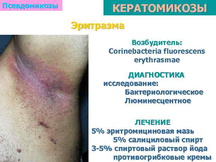 Псевдомикозы КЕРАТОМИКОЗЫ Эритразма Возбудитель: Corinebacteria fluorescens erythrasmae ДИАГНОСТИКА исследование: Бактериологическое Люминесцентное ЛЕЧЕНИЕ 5% эритромициновая