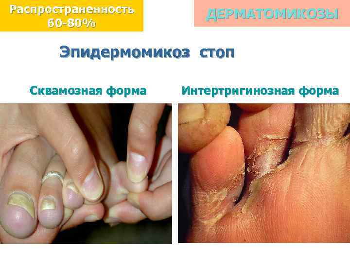 Распространенность 60 -80% ДЕРМАТОМИКОЗЫ Эпидермомикоз стоп Сквамозная форма Интертригинозная форма 