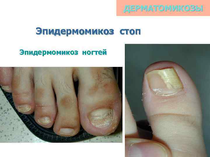 ДЕРМАТОМИКОЗЫ Эпидермомикоз стоп Эпидермомикоз ногтей 