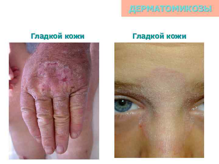 ДЕРМАТОМИКОЗЫ Гладкой кожи 