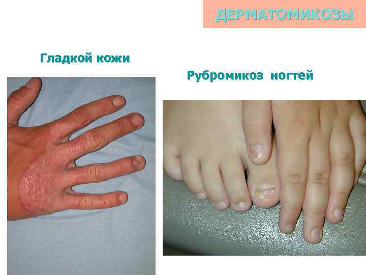 ДЕРМАТОМИКОЗЫ Гладкой кожи Рубромикоз ногтей 