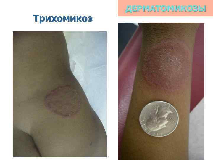 Трихомикоз ДЕРМАТОМИКОЗЫ 