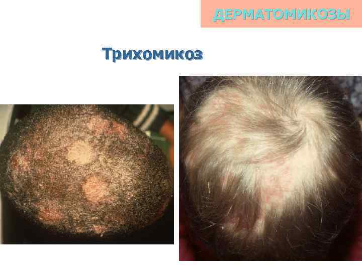 ДЕРМАТОМИКОЗЫ Трихомикоз 