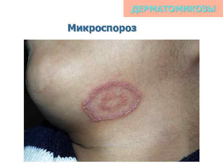 ДЕРМАТОМИКОЗЫ Микроспороз 