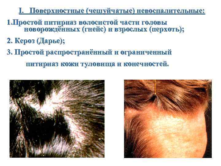 I. Поверхностные (чешуйчатые) невоспалительные: 1. Простой питириаз волосистой части головы новорождённых (гнейс) и взрослых