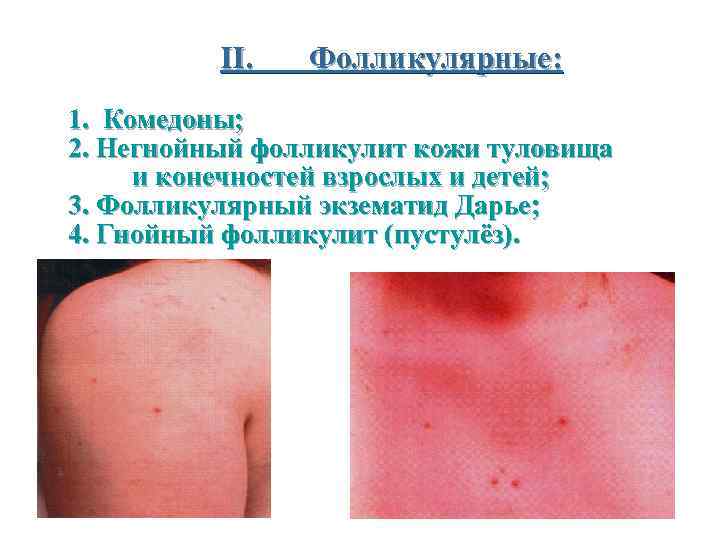 II. Фолликулярные: 1. Комедоны; 2. Негнойный фолликулит кожи туловища и конечностей взрослых и детей;