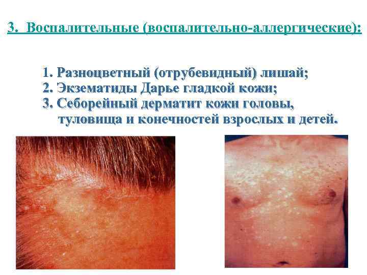  3. Воспалительные (воспалительно-аллергические): 1. Разноцветный (отрубевидный) лишай; 2. Экзематиды Дарье гладкой кожи; 3.