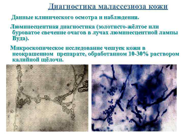  Диагностика малассезиоза кожи Данные клинического осмотра и наблюдения. Люминесцентная диагностика (золотисто-жёлтое или буроватое