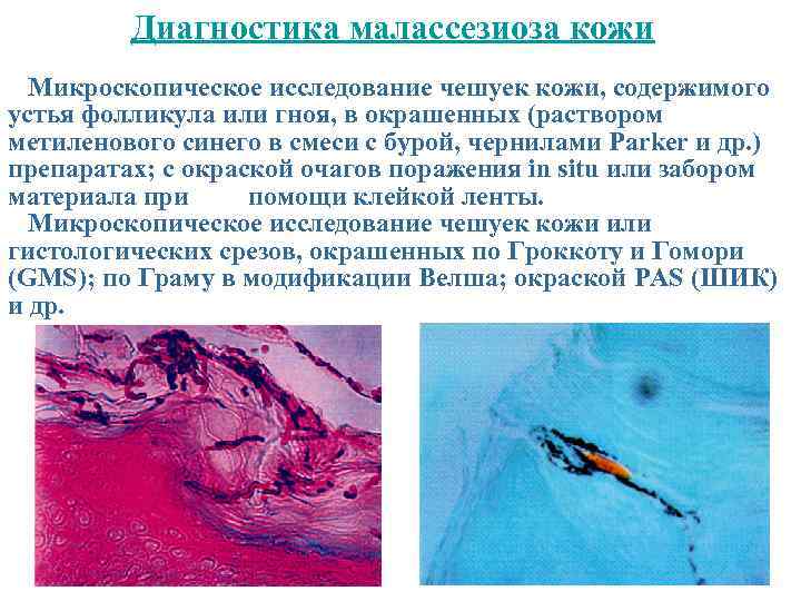 Диагностика малассезиоза кожи Микроскопическое исследование чешуек кожи, содержимого устья фолликула или гноя, в окрашенных