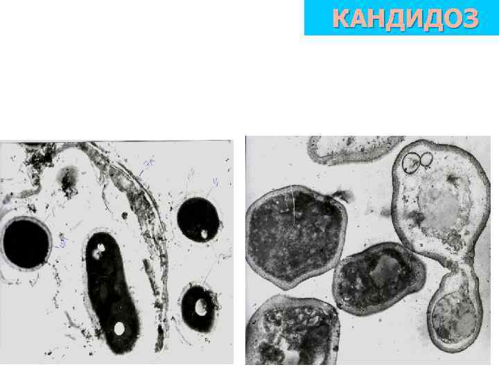 КАНДИДОЗ 