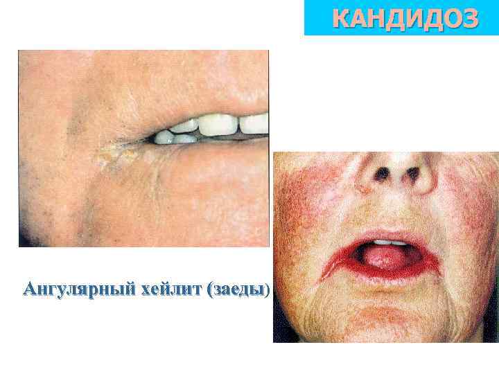 КАНДИДОЗ Ангулярный хейлит (заеды) 