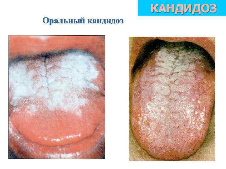 КАНДИДОЗ Оральный кандидоз 