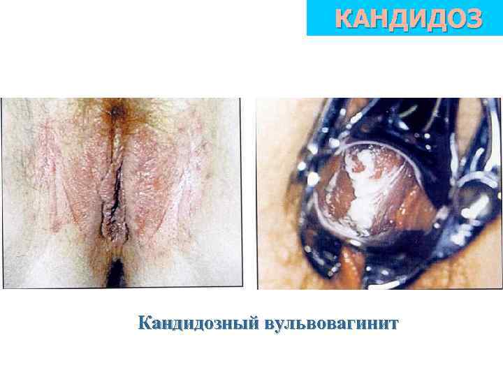 КАНДИДОЗ Кандидозный вульвовагинит 