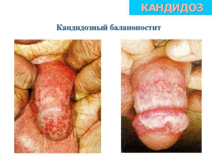 КАНДИДОЗ Кандидозный баланопостит 
