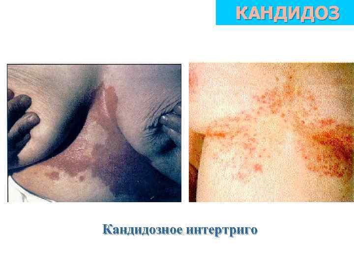 КАНДИДОЗ Кандидозное интертриго 