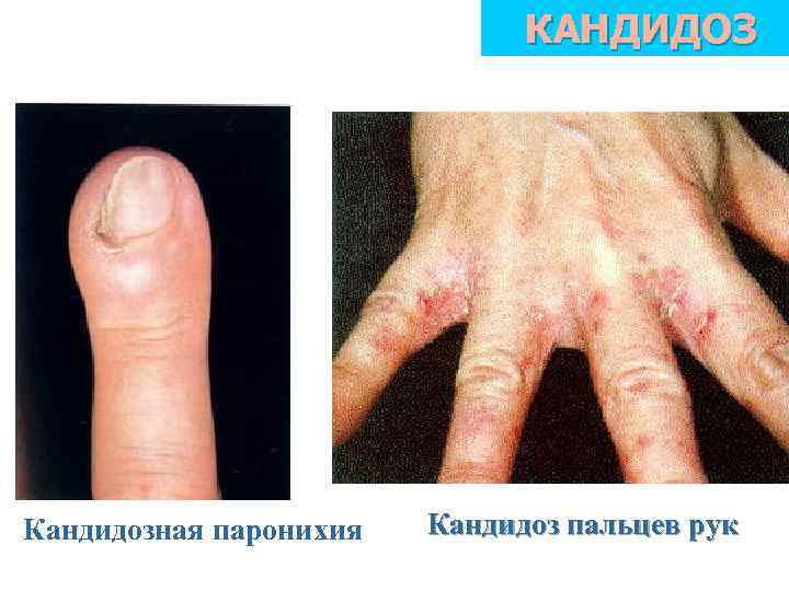 КАНДИДОЗ Кандидозная паронихия Кандидоз пальцев рук 
