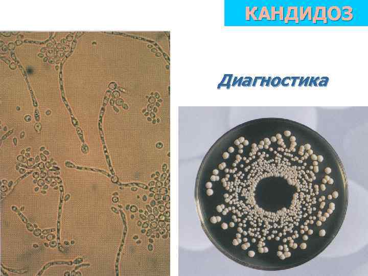 КАНДИДОЗ Диагностика 