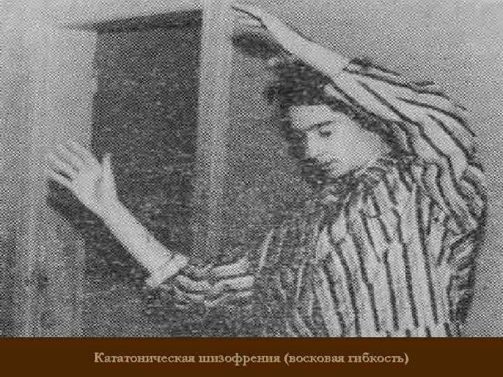 Кататоническая шизофрения (восковая гибкость) 