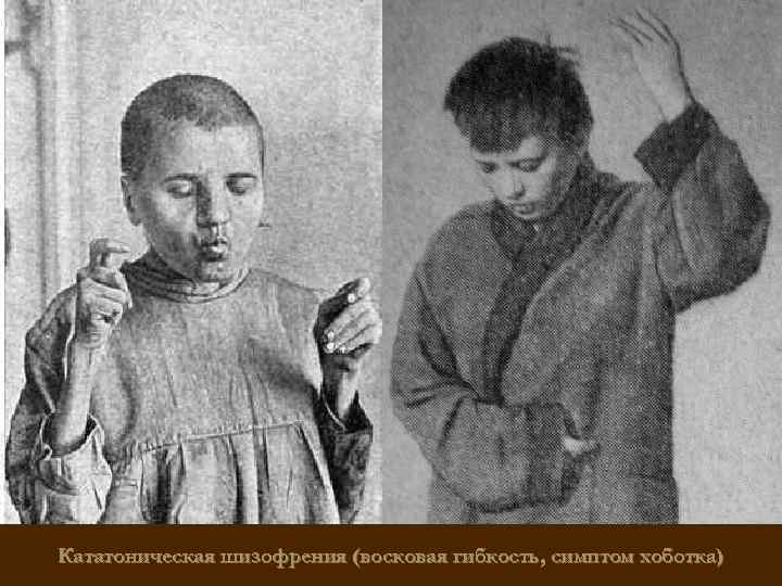 Кататоническая шизофрения (восковая гибкость, симптом хоботка) 