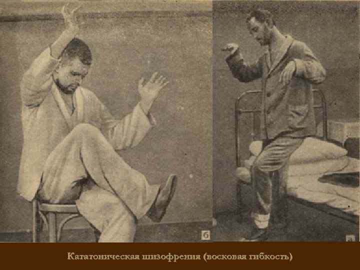 Кататоническая шизофрения (восковая гибкость) 