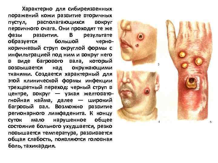 Характерно для сибиреязвенных поражений кожи развитие вторичных пустул, располагающихся вокруг первичного очага. Они проходят