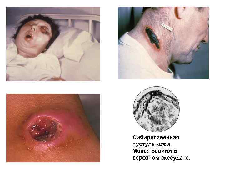 Сибиреязвенная пустула кожи. Масса бацилл в серозном экссудате. 