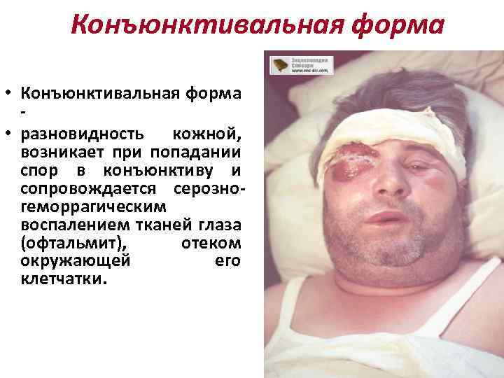 Конъюнктивальная форма • Конъюнктивальная форма - • разновидность кожной, возникает при попадании спор в