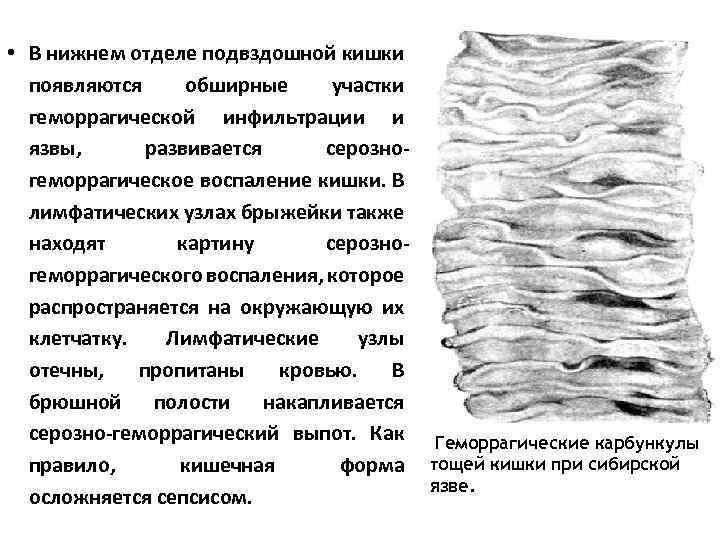  • В нижнем отделе подвздошной кишки появляются обширные участки геморрагической инфильтрации и язвы,