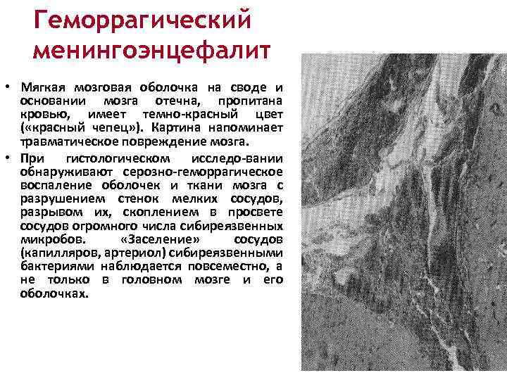 Геморрагический менингоэнцефалит • Мягкая мозговая оболочка на своде и основании мозга отечна, пропитана кровью,