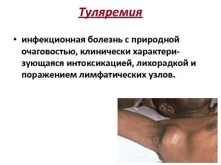 Туляремия • инфекционная болезнь с природной очаговостью, клинически характеризующаяся интоксикацией, лихорадкой и поражением лимфатических