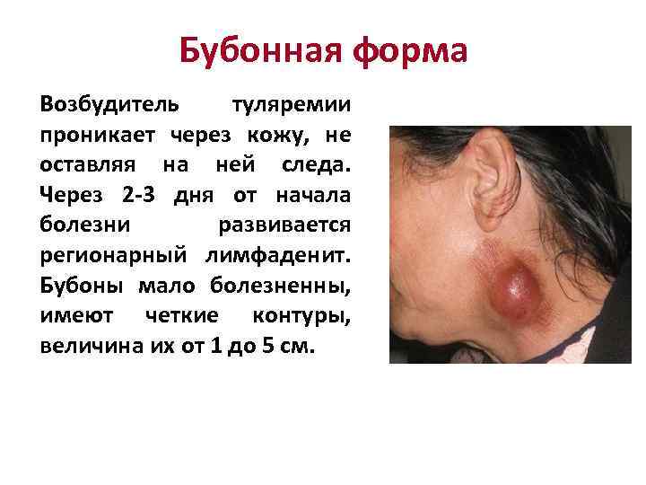 Бубонная форма Возбудитель туляремии проникает через кожу, не оставляя на ней следа. Через 2