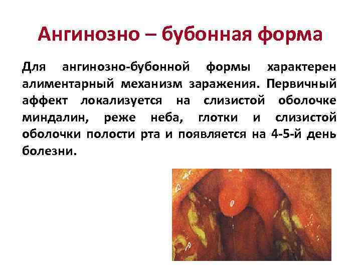 Ангинозно – бубонная форма Для ангинозно-бубонной формы характерен алиментарный механизм заражения. Первичный аффект локализуется