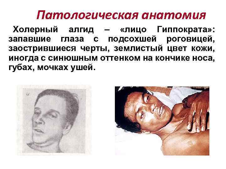 Патологическая анатомия Холерный алгид – «лицо Гиппократа» : запавшие глаза с подсохшей роговицей, заострившиеся