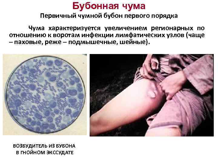 Бубонная чума Первичный чумной бубон первого порядка Чума характеризуется увеличением регионарных по отношению к