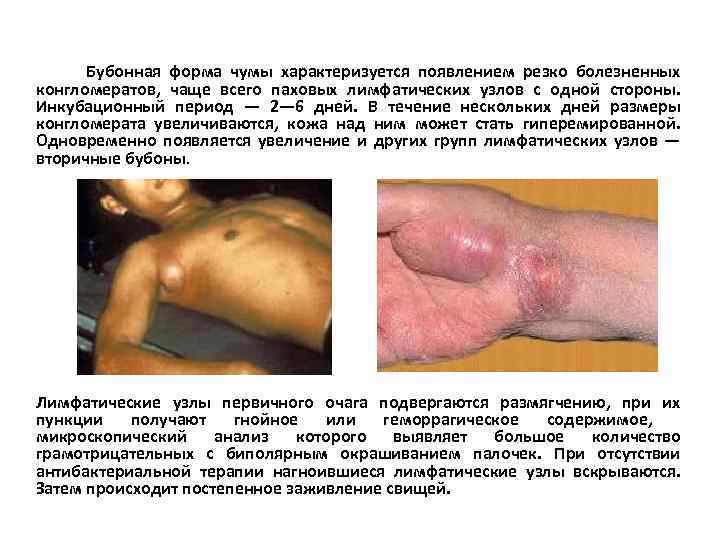  Бубонная форма чумы характеризуется появлением резко болезненных конгломератов, чаще всего паховых лимфатических узлов