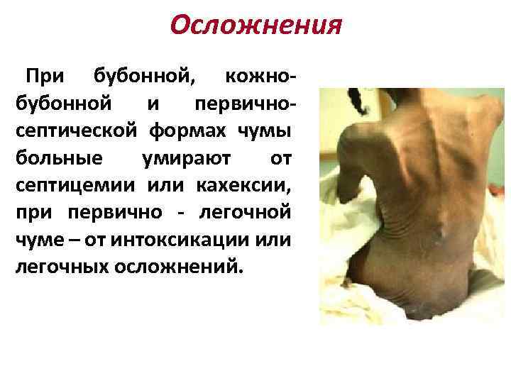 Осложнения При бубонной, кожнобубонной и первичносептической формах чумы больные умирают от септицемии или кахексии,