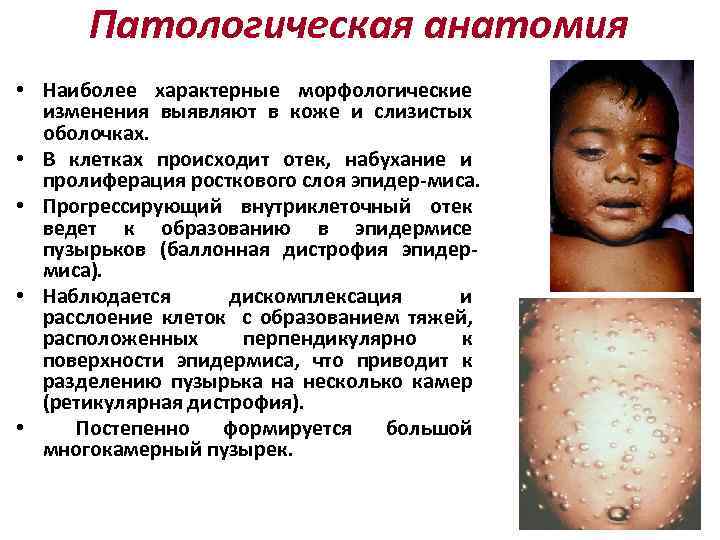 Патологическая анатомия • Наиболее характерные морфологические изменения выявляют в коже и слизистых оболочках. •