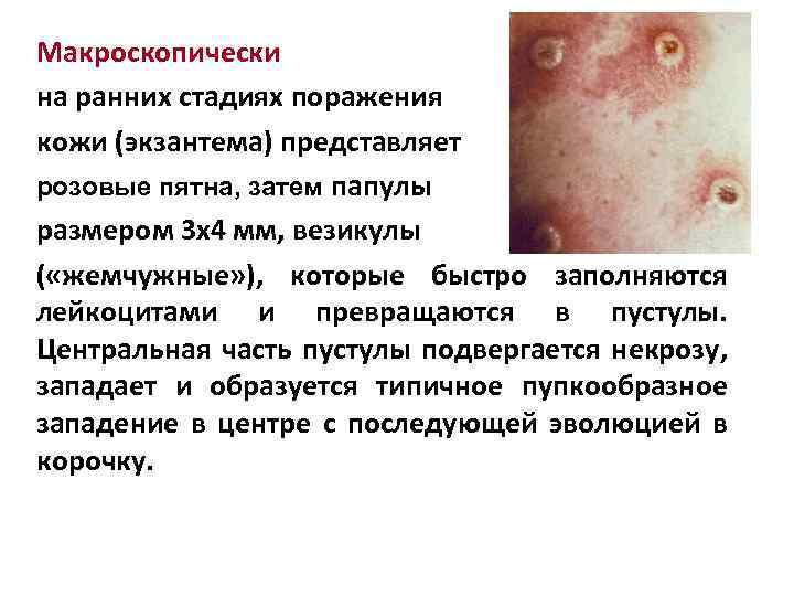Макроскопически на ранних стадиях поражения кожи (экзантема) представляет розовые пятна, затем папулы размером 3