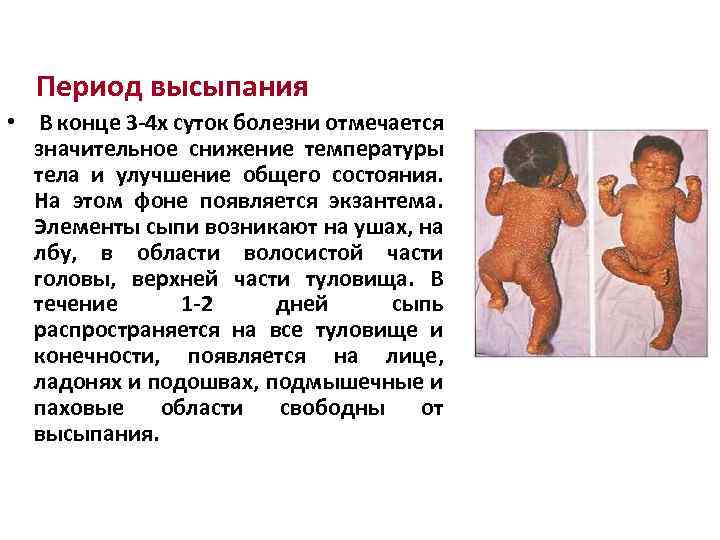  Период высыпания • В конце 3 -4 х суток болезни отмечается значительное снижение