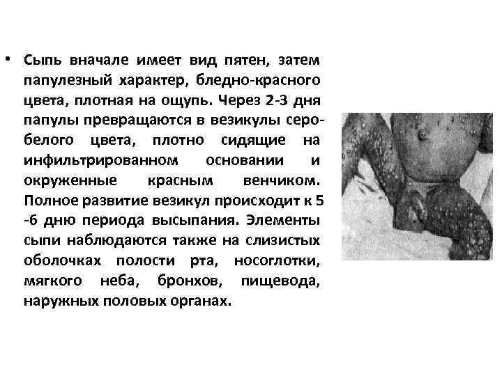  • Сыпь вначале имеет вид пятен, затем папулезный характер, бледно-красного цвета, плотная на