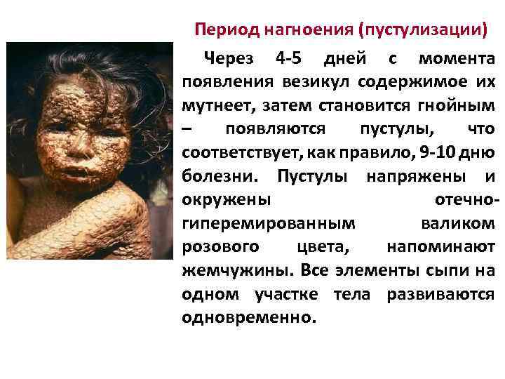 Период нагноения (пустулизации) Через 4 -5 дней с момента появления везикул содержимое их мутнеет,