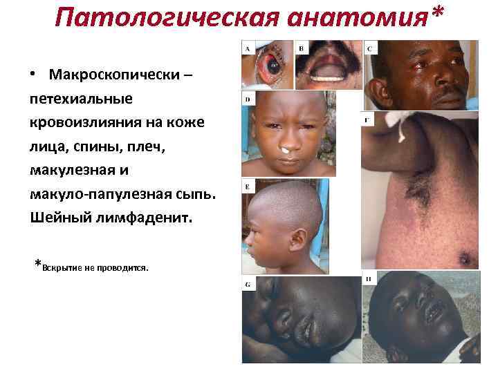 Патологическая анатомия* • Макроскопически – петехиальные кровоизлияния на коже лица, спины, плеч, макулезная и