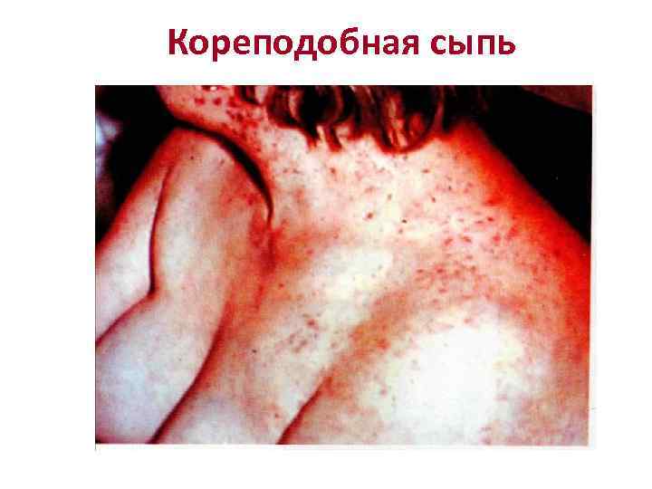 Кореподобная сыпь 